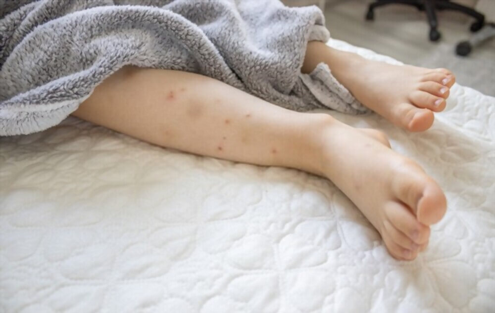 how to prevent bed bug bites while sleeping